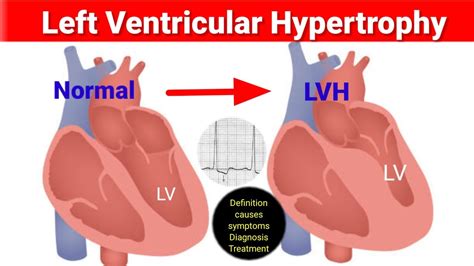 lvh medical abbreviation|left ventricular hypertrophy symptoms treatment.